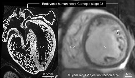 non compacted lv|non compaction cardiomyopathy guidelines.